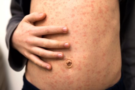 Measles Cases in North Texas Town up to 5, Health Officials Say